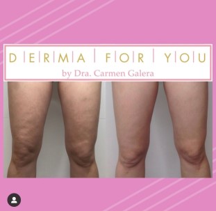 AntesDespues tratamiento celulitis Legacy